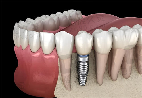 青岛种植牙齿哪家医院最好?青岛十大牙科口腔医院推荐