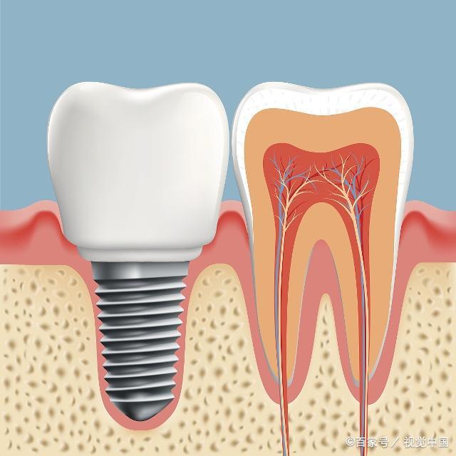 种植牙全流程：时间、准备和注意事项