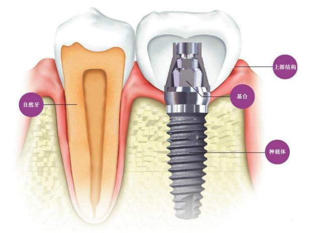 种牙大概需要多久？去医院几次？